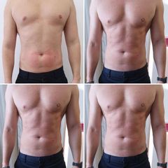 Emsculpt NEO - MEDICOM Clinic