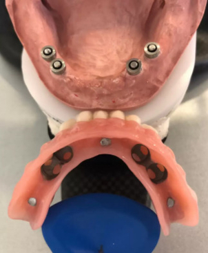 Pre koho sú miniimplantáty vhodné