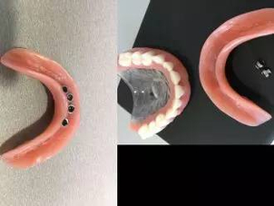 Prvá konzultácia pred vložením miniimplantátov