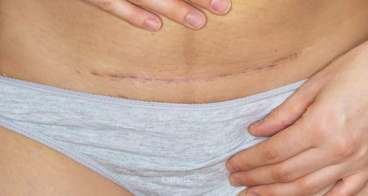 Abdominoplastika – pooperačná starostlivosť