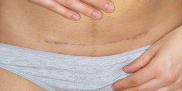 Abdominoplastika – pooperačná starostlivosť