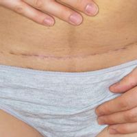 Abdominoplastika – pooperačná starostlivosť
