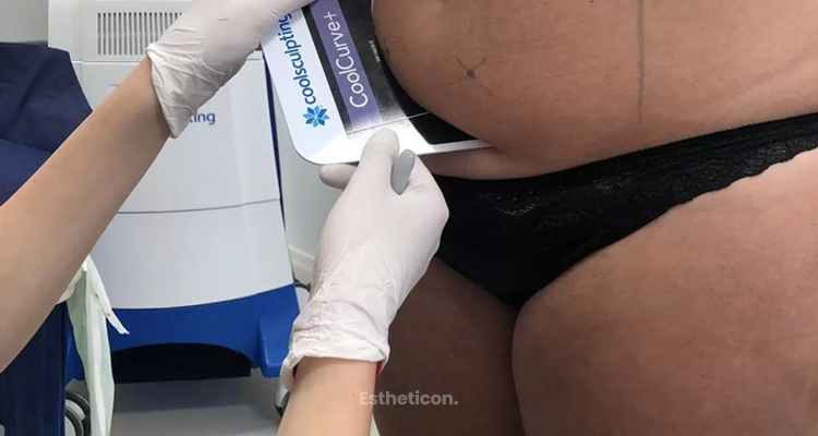 Neinvazívna liposukcia Coolsculpting pomôže s tvrdohlavým tukom