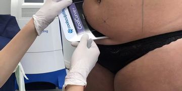Neinvazívna liposukcia Coolsculpting pomôže s tvrdohlavým tukom