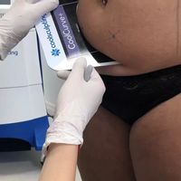 Neinvazívna liposukcia Coolsculpting pomôže s tvrdohlavým tukom