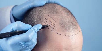 Transplantácia vlasov pomocou Neograft 2.0 v NESTORY medical centre