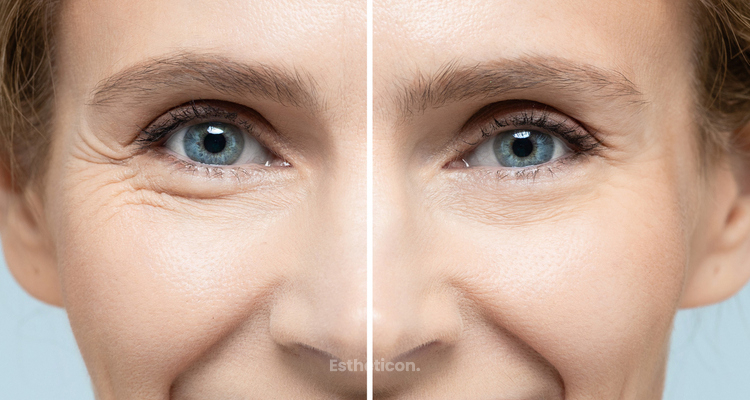 Stimulátory kolagénu vs. kyselina hyalurónová: ktoré ošetrenie je vhodnejšie na omladenie pleti?