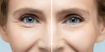 Stimulátory kolagénu vs. kyselina hyalurónová: ktoré ošetrenie je vhodnejšie na omladenie pleti? Stimulátory kolagénu vs. kyselina hyalurónová: ktoré ošetrenie je vhodnejšie na omladenie pleti?