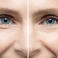 Stimulátory kolagénu vs. kyselina hyalurónová: ktoré ošetrenie je vhodnejšie na omladenie pleti?