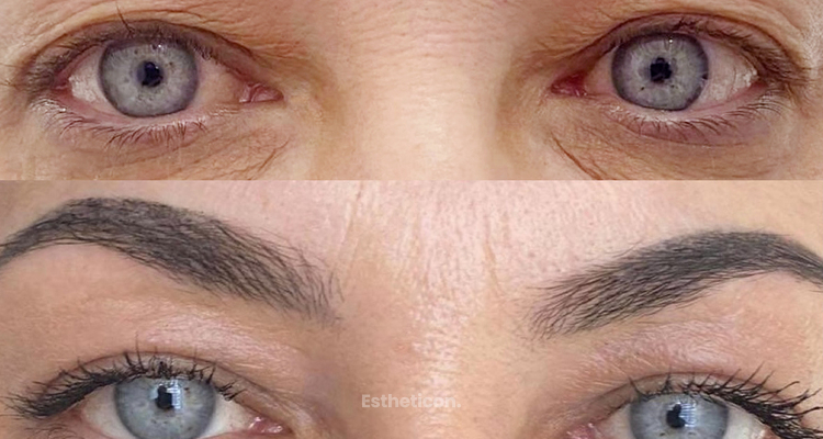 Nechirurgická blefaroplastika s prístrojom Plasmaskin