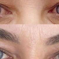 Nechirurgická blefaroplastika s prístrojom Plasmaskin