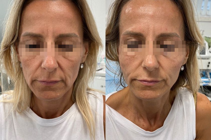 Anti aging pred a po - 868082