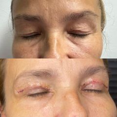 Blefaroplastika - FB CLINIC