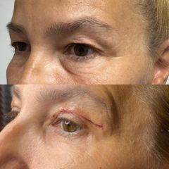 Blefaroplastika - FB CLINIC