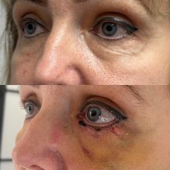 Blefaroplastika - FB CLINIC