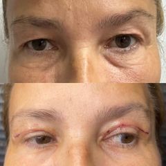 Blefaroplastika - FB CLINIC