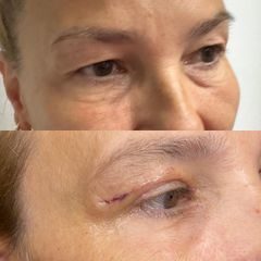 Blefaroplastika - FB CLINIC