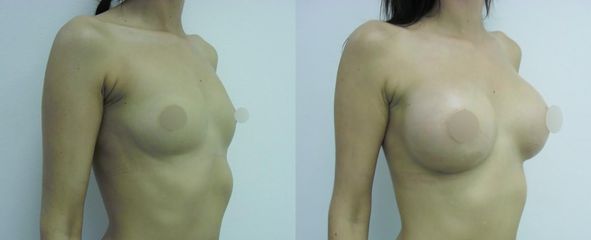 Zväčšenie prsníkov (Augmentácia) - Avelane Clinic