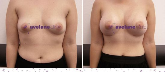 Zväčšenie pŕs - Avelane Clinic