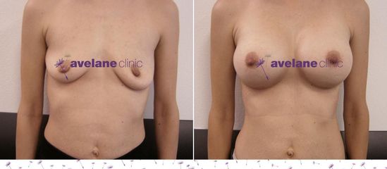 Zväčšenie pŕs - Avelane Clinic