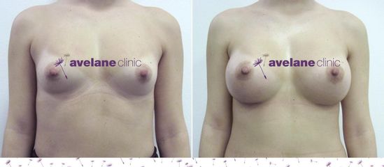 Zväčšenie pŕs - Avelane Clinic