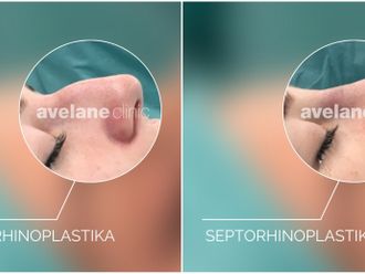 Rhinoplastika - 855027