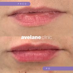 Zväčšenie pier - Avelane Clinic