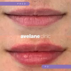 Zväčšenie pier - Avelane Clinic