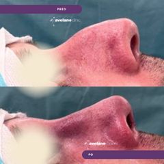 Rhinoplastika - Avelane Clinic