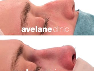 Rhinoplastika pred a po - 878575