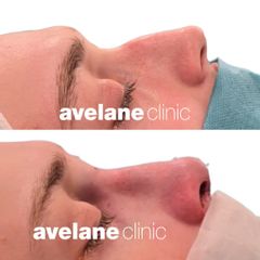 Rhinoplatika MUDr. Daniel Mládek, PhD., MPH