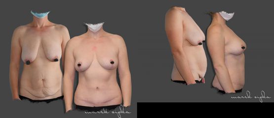 Abdominoplastika s modeláciou prsníkov