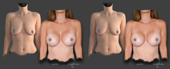 5 MESIACOV po augmentácii prsníkov s modeláciou.
