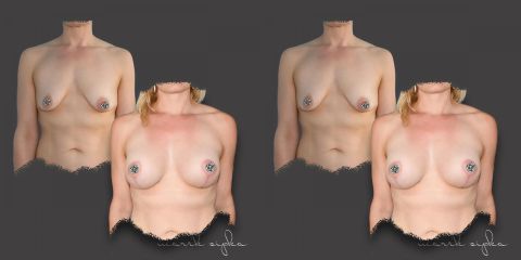 6 MESIACOV po augmentácii s modeláciou prsníkov.