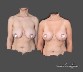 Augmentácia s modeláciou - MUDr. Marek Šipka