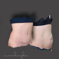 Abdominoplastika - MUDr. Marek Šipka