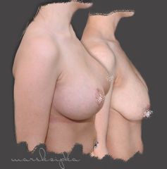 Mastopexia - MUDr. Marek Šipka