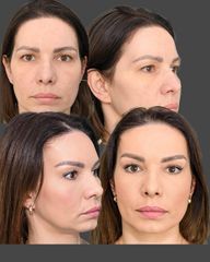 browlift - MUDr. Marek Šipka