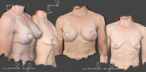 Zväčšenie pŕs s modeláciou - MUDr. Marek Šipka