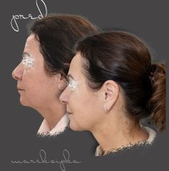 Necklift - MUDr. Marek Šipka