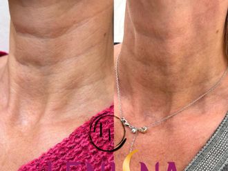 Anti aging pred a po - 874761