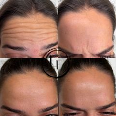 Botulotoxín čelo + glabella