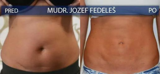 BEFORE lipo1