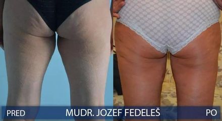 BEFORE lipo3