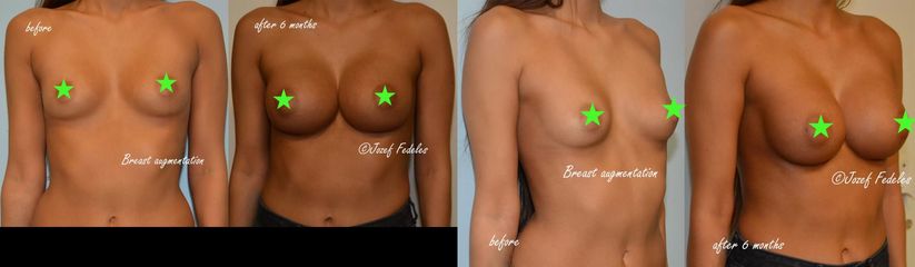 Breast augmentation