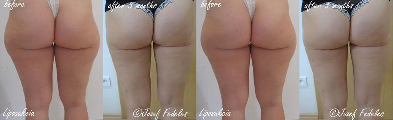 Liposukcia vonkajšie a vnútorné stehná
