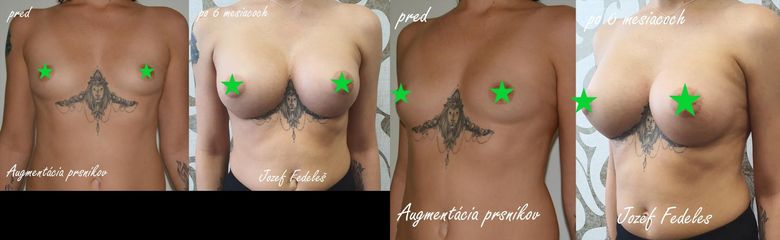 Augmentácia prsníkov