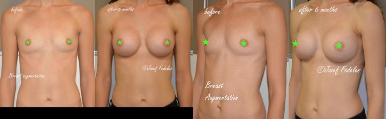 okrúhle implantáty Motiva 340 ml demi profil
