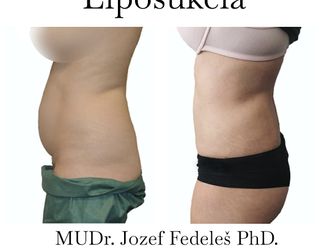 Liposukcia pred a po - 858533