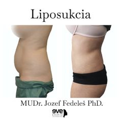 Liposukcia - MUDr. Jozef Fedeleš PhD.